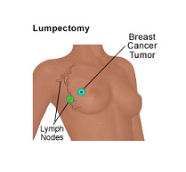 Cost Breast Cancer Surgery in India