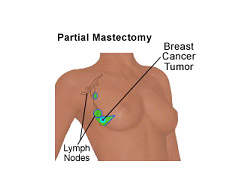 Cost Breast Cancer Surgery in India