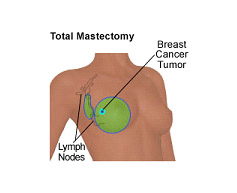 Cost Breast Cancer Surgery in India
