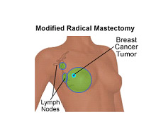 Cost Breast Cancer Surgery in India