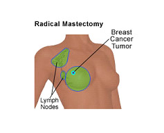 Cost Breast Cancer Surgery in India