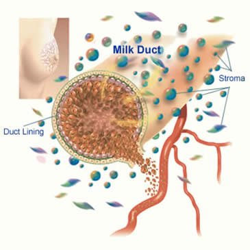 Best Breast Cancer Treatment in India