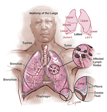 Lung Cancer Treatment in India