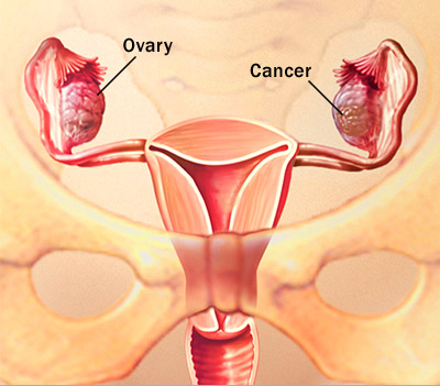 Ovarian Cancer Treatment India