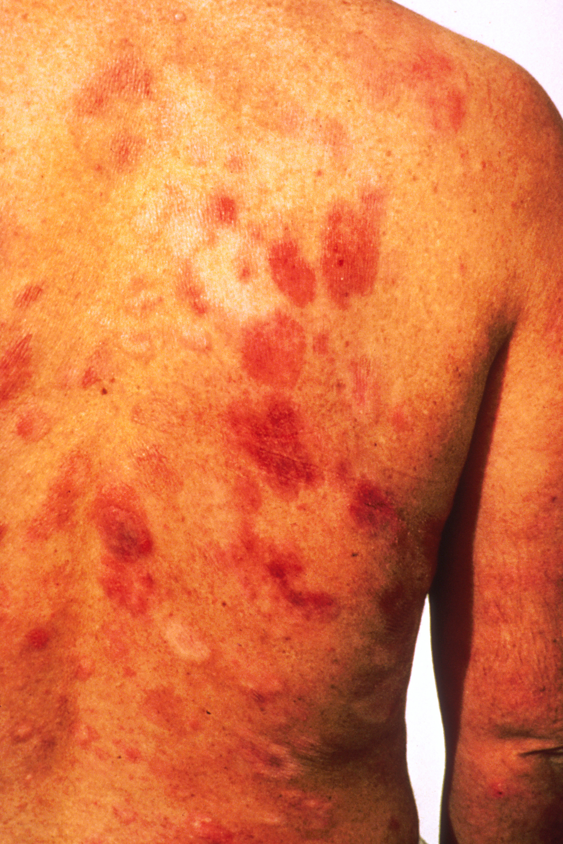 Sarcoma Cancer Treatment