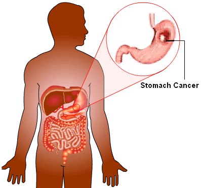 Stomach Cancer