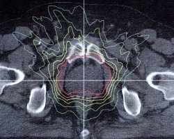 IMRT  Dostribution Prostate Cancer